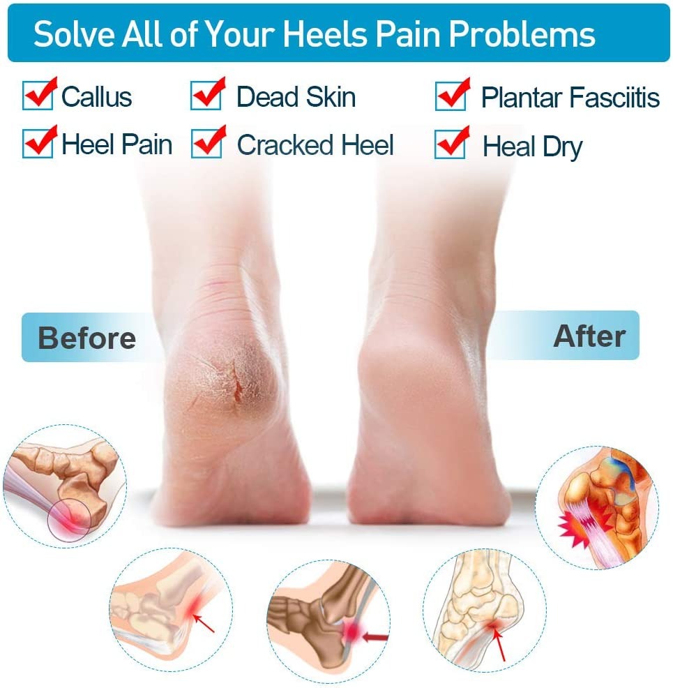 Silicone Heel Protector Sleeve for Cracked Heels & Pain Relief – Breathable & Cushioned Support.